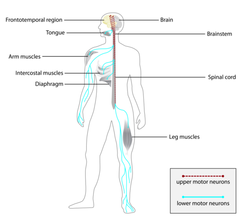 Amyotrophic lateral sclerosis